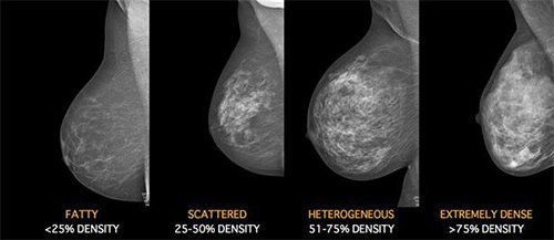 Do you have a greater risk of breast cancer if your breasts are big or small ?
